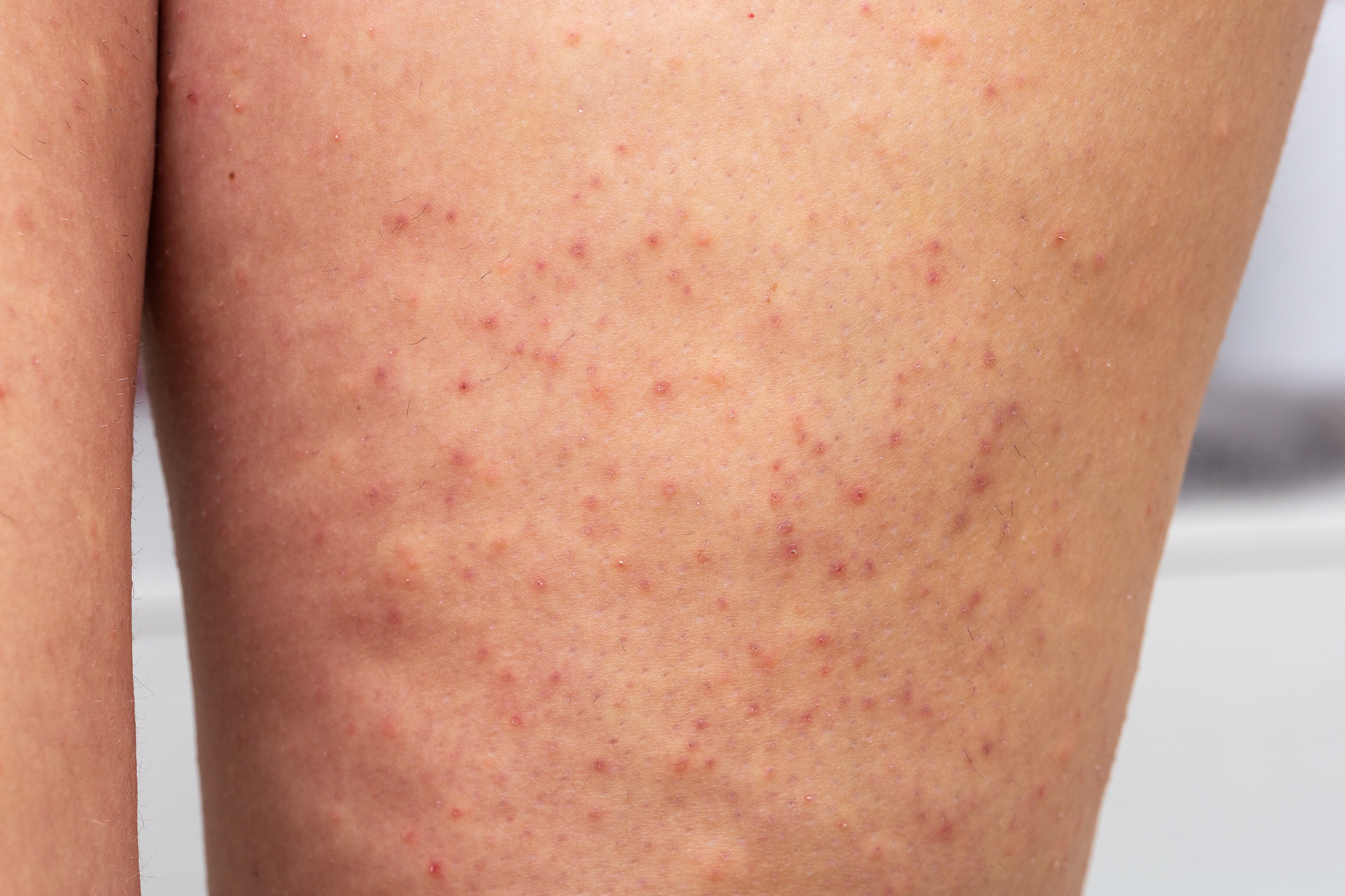 Depilación - foliculitis