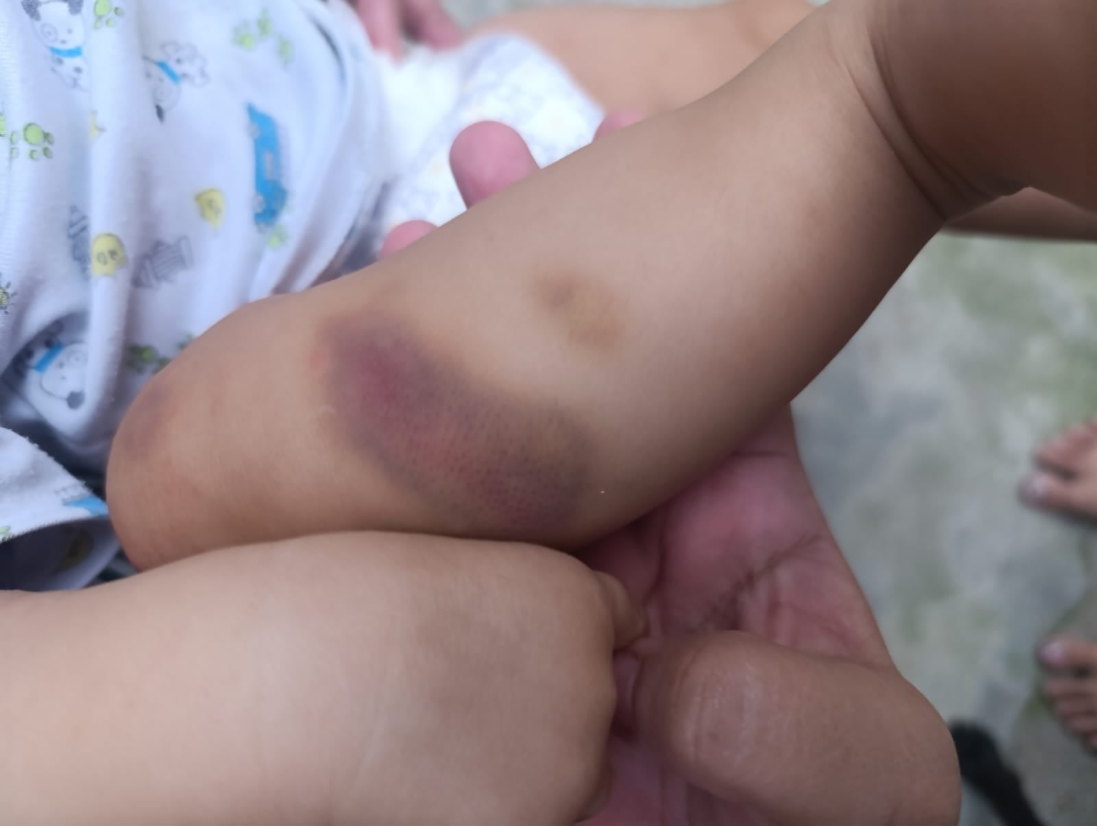 Hendrick Samuel tiene 17 meses y padece hemofilia A severa. Fue diagnosticado a los cuatro meses y no recibía su medicamento desde diciembre de 2025.