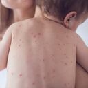 Sarampión - imagen de referencia