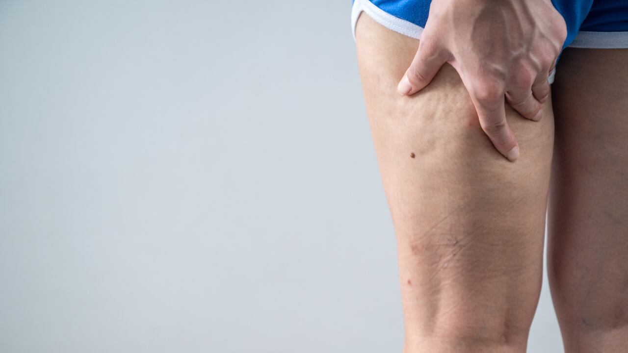 La celulitis suele afectar principalmente a las mujeres.