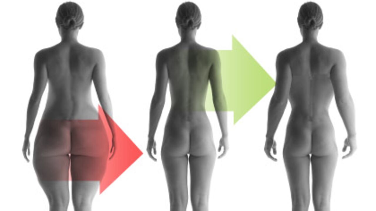 En el estudio, las mujeres se sometieron a liposucción en el abdomen bajo y los muslos. Al cabo de un año, la grasa se instaló en otras partes del cuerpo, especialmente el abdomen superior, los brazos y la espalda.