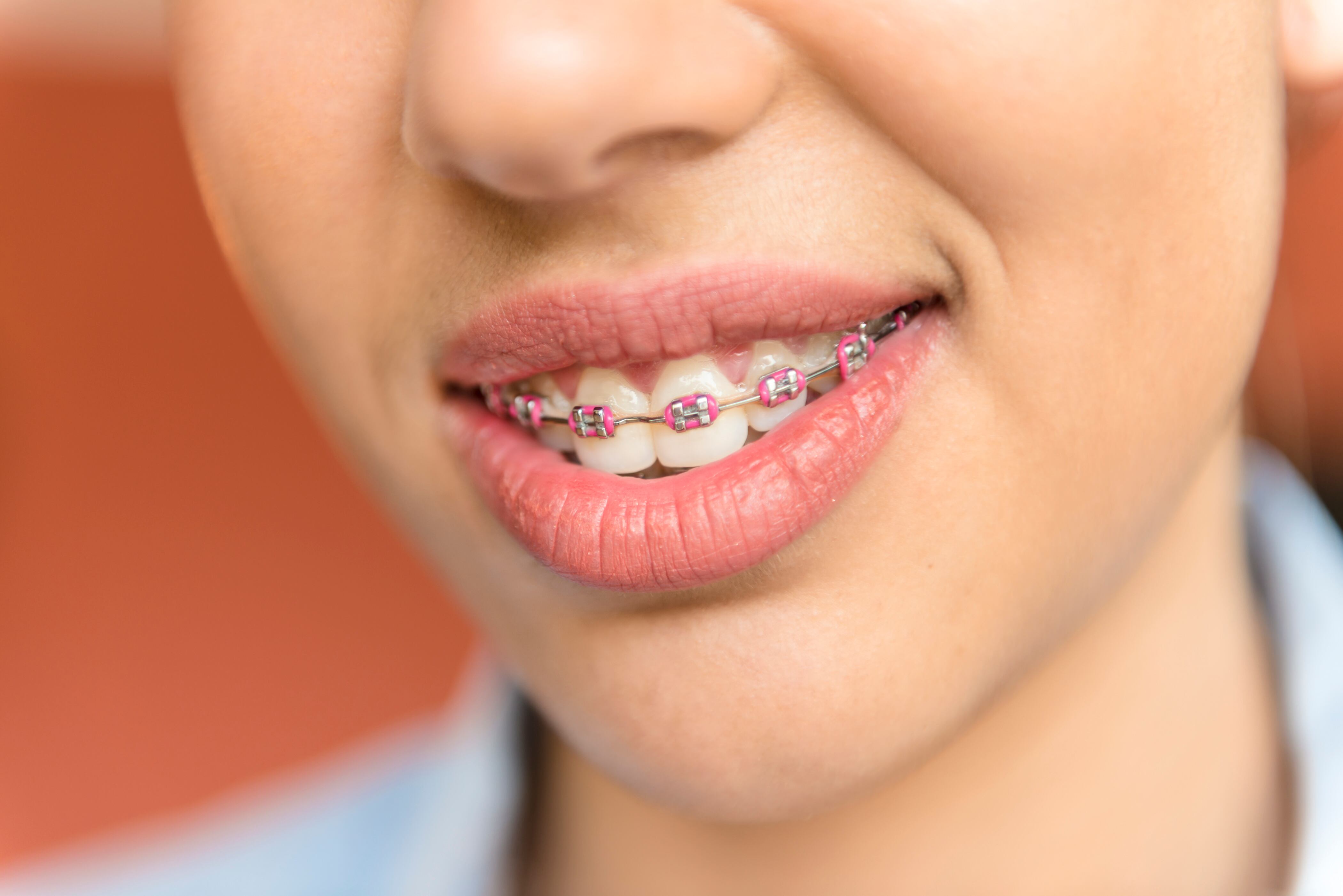 Este es el mejor color de brackets.