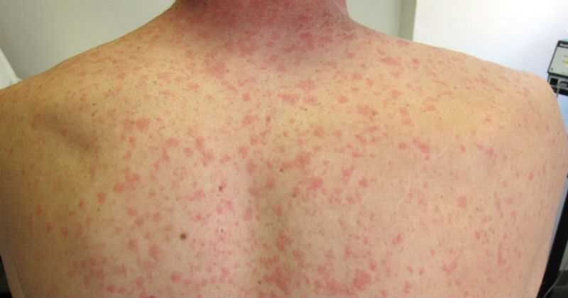 En la mayoría de los casos, las vasculitis que tienen que ver con el sistema inmune 