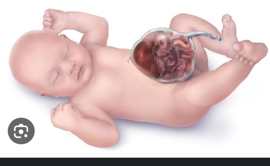 Representación gráfica de la onfalocele gigante.