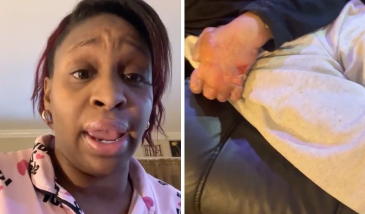 La víctima tenía sus manos completamente congeladas y quemadas por cuenta del frío