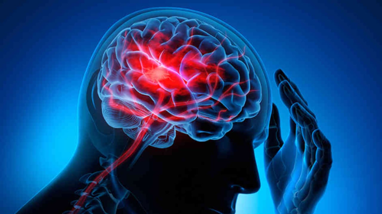 La presión arterial alta es el principal factor de riesgo para los accidentes cerebrovasculares.