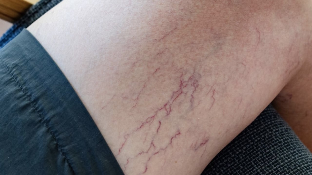 Consumir vitamina K mejora la circulación de la sangre.