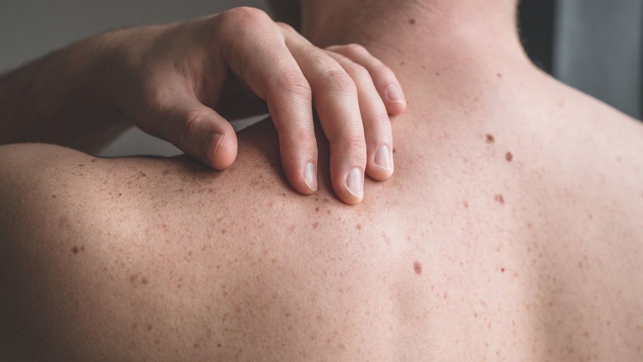 En Colombia, la incidencia de melanoma maligno es de 4,6 por cada 100.000 mujeres y de 4,4 por cada 100.000 hombres.