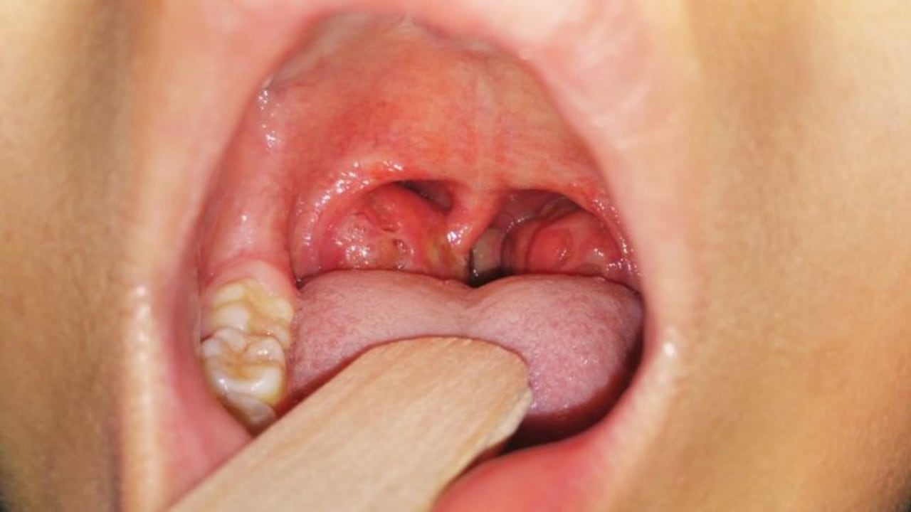 Las complicaciones en las amígdalas también pueden aumentar la cantidad de bacterias.