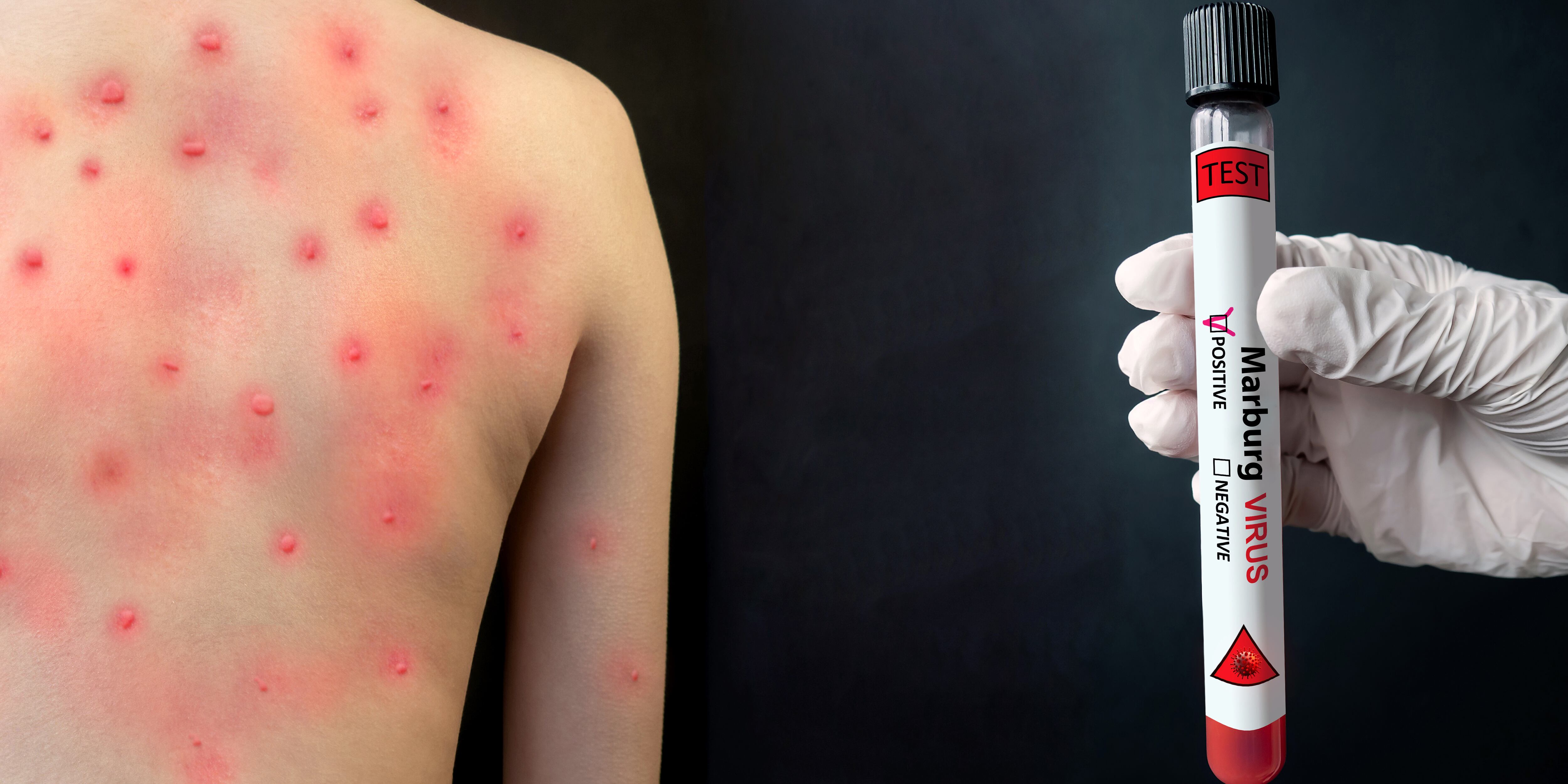 El virus de Marburgo se transmite a seres humanos desde murciélagos de árboles frutales