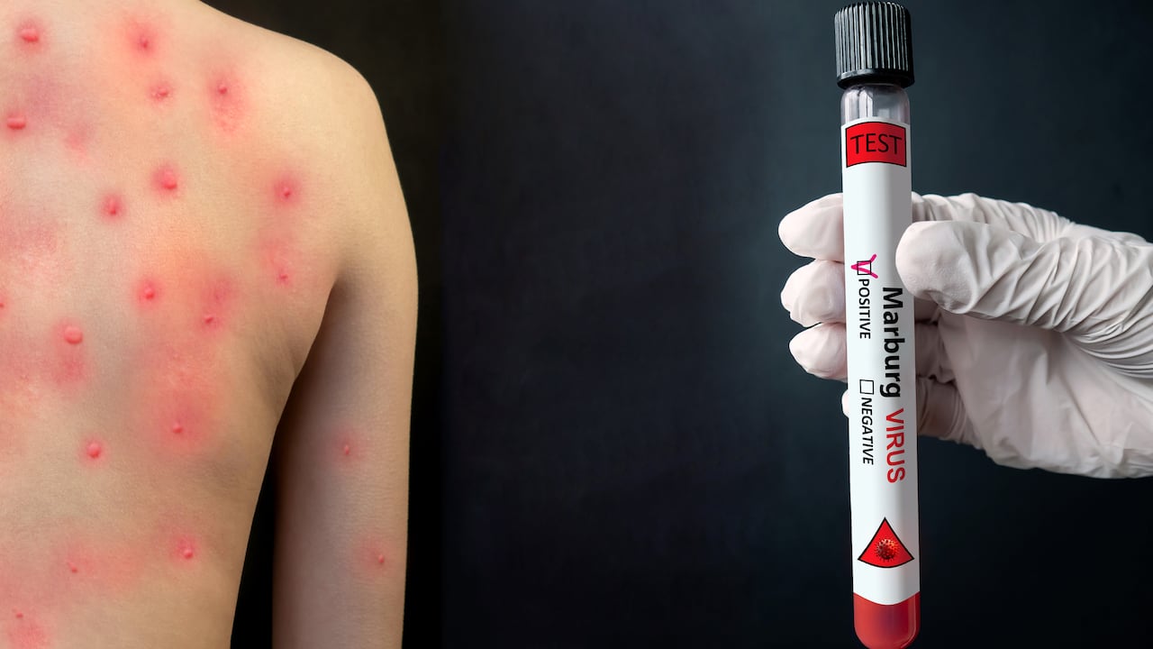 No existen vacunas ni tratamientos antivirales aprobados para tratar el virus de Marbugo.