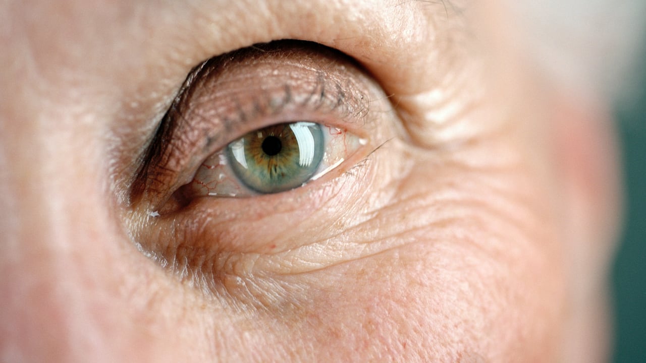 Parpados envejecidos