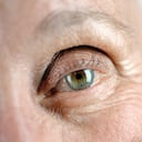 Parpados envejecidos