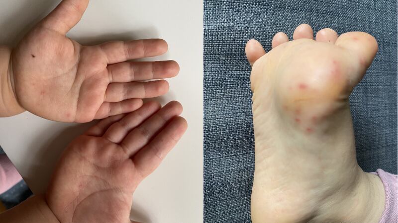 Síndrome de manos, pies y boca: ¿por qué 32 casos en Cali no se traducen en alarma?