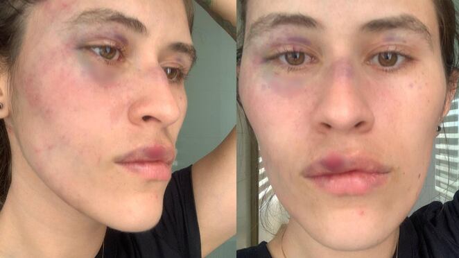 “Fui a hablar con mi ex y terminé golpeada”: un nuevo caso de maltrato contra la mujer