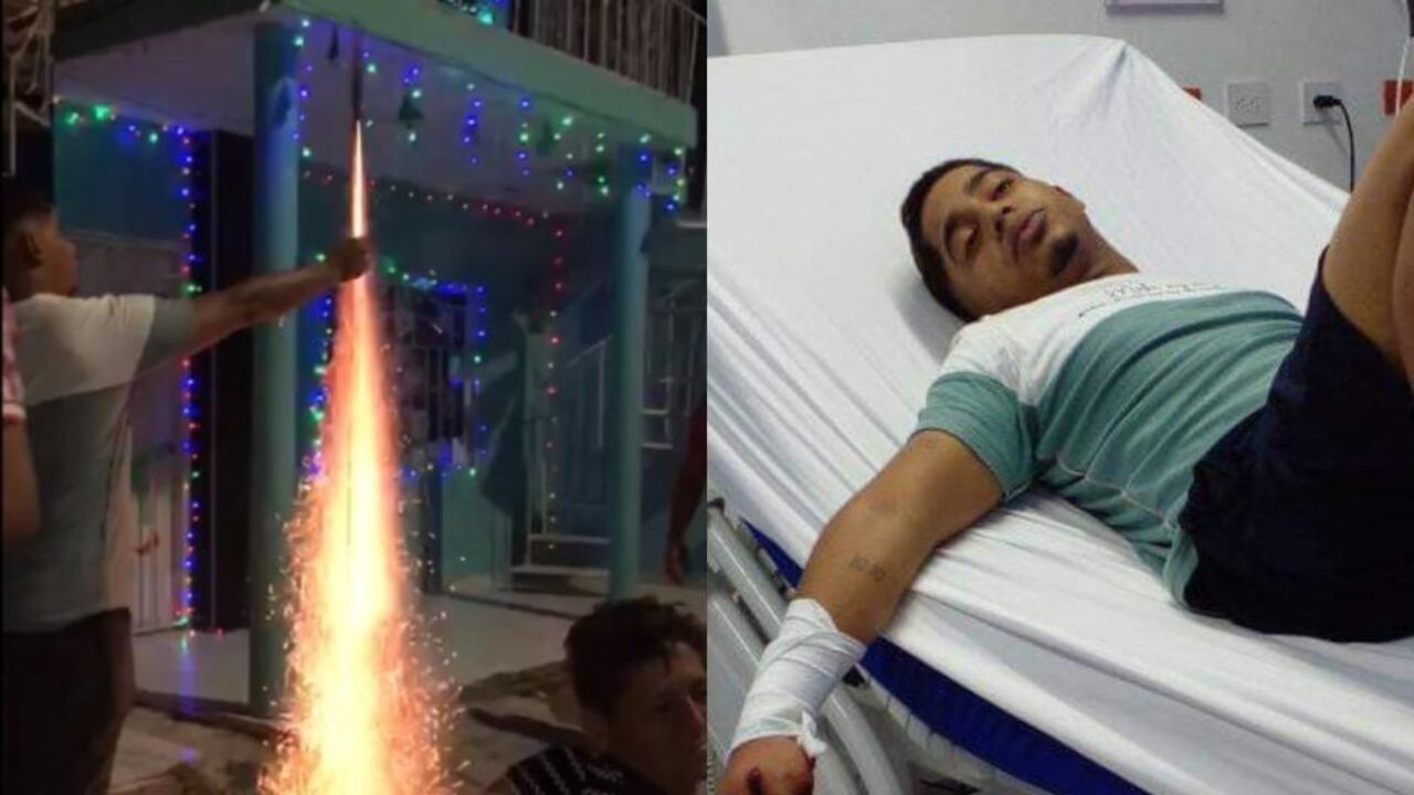 Isidro Andrés Rojas, de 21 años perdió tres dedos de su mano derecha tras encender un artefacto pirotécnico.