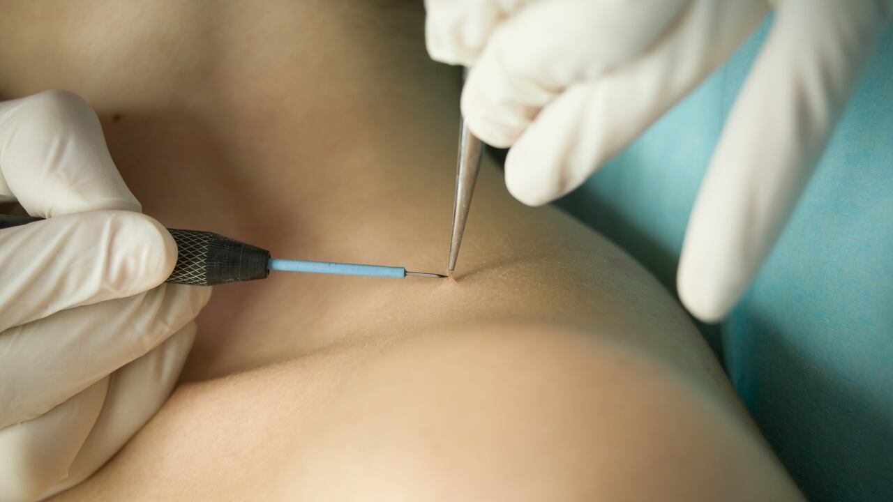 Wart removing near neck