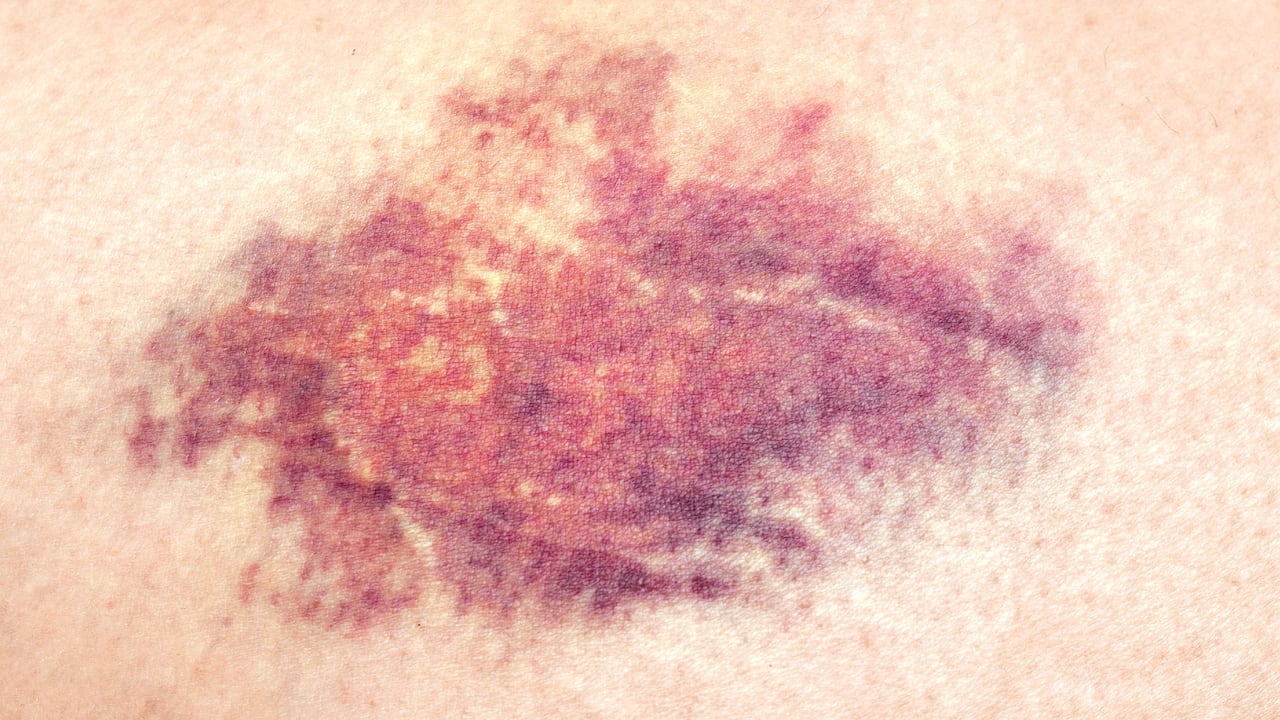 Moretones y manchas de sangre debajo de la piel.