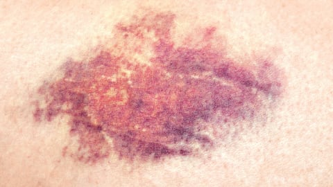 Moretones y manchas de sangre debajo de la piel.