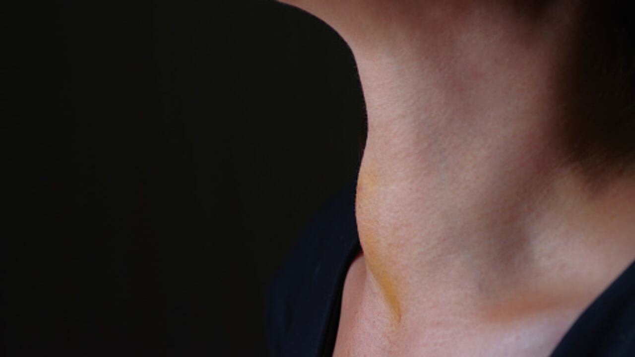 Frente al hipotiroidismo (cuando no produce suficiente hormona tiroidea), los síntomas se relacionan con una disminución en la actividad funcional de todos los sistemas del organismo.