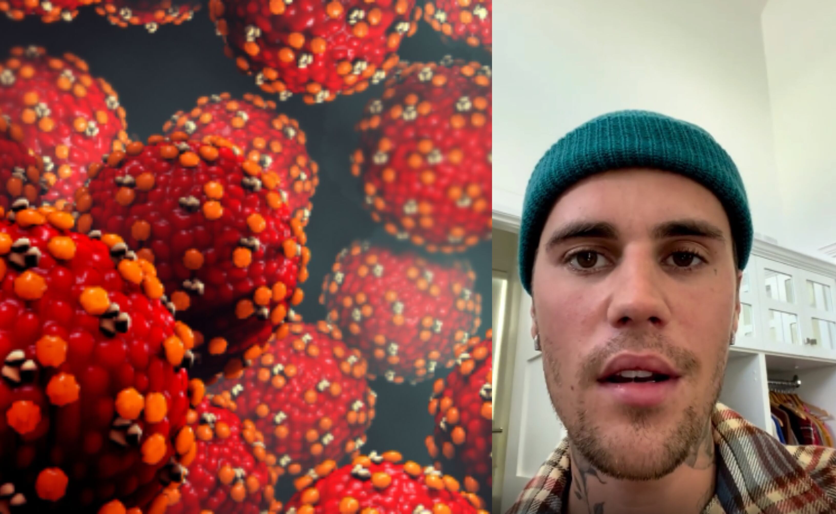 El síndrome de Ramsay Hunt ocurre en personas que han tenido varicela. Justin Bieber anunció recientemente que lo padece.