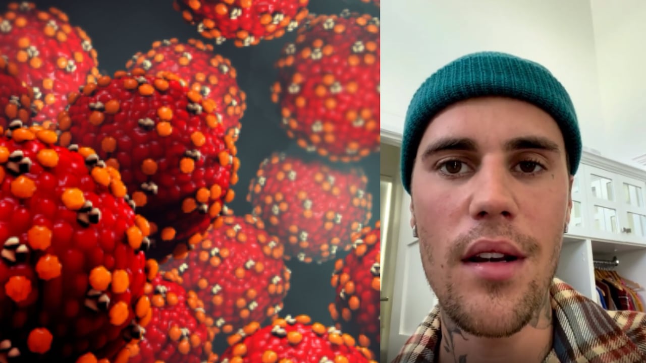 El síndrome de Ramsay Hunt ocurre en personas que han tenido varicela. Justin Bieber anunció recientemente que lo padece.