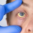 La coloración amarilla en ojos no es habitual. Esta situación es conocida como ictericia y es una clara señal de que existe algún problema en el funcionamiento del hígado.