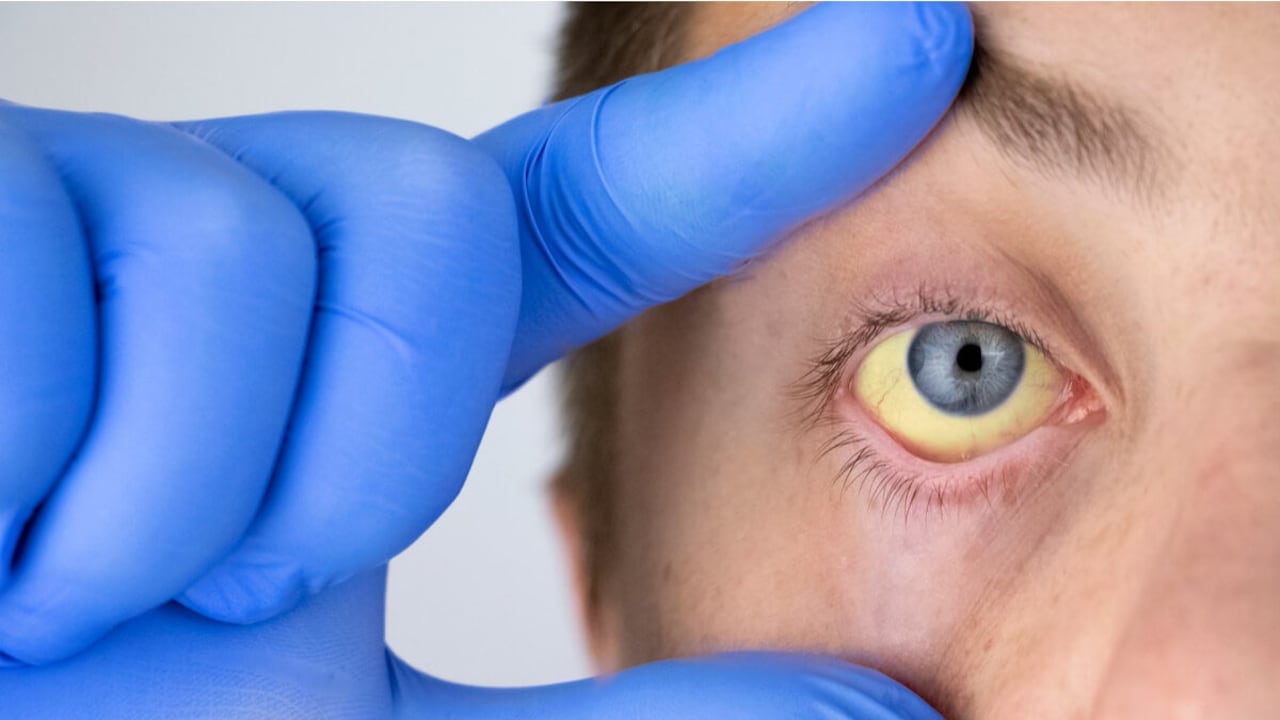 La ictericia es a menudo un signo de un problema con el hígado, la vesícula biliar o el páncreas.