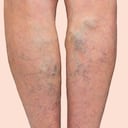 Las várices son problemas circulatorios.