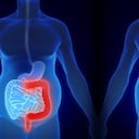 La colitis ulcerosa puede ser leve o grave dependiendo en qué parte del colon se ubique.