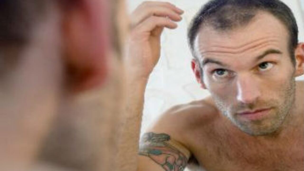 La caída del cabello asociada al covid-19 ha sido reportada en varios estudios.