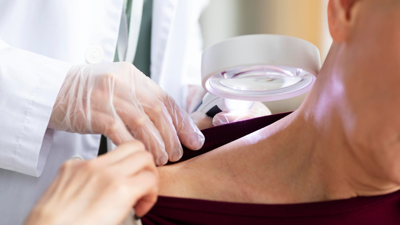 El melanoma es el tipo de cáncer de piel que causa el mayor porcentaje de mortalidad.