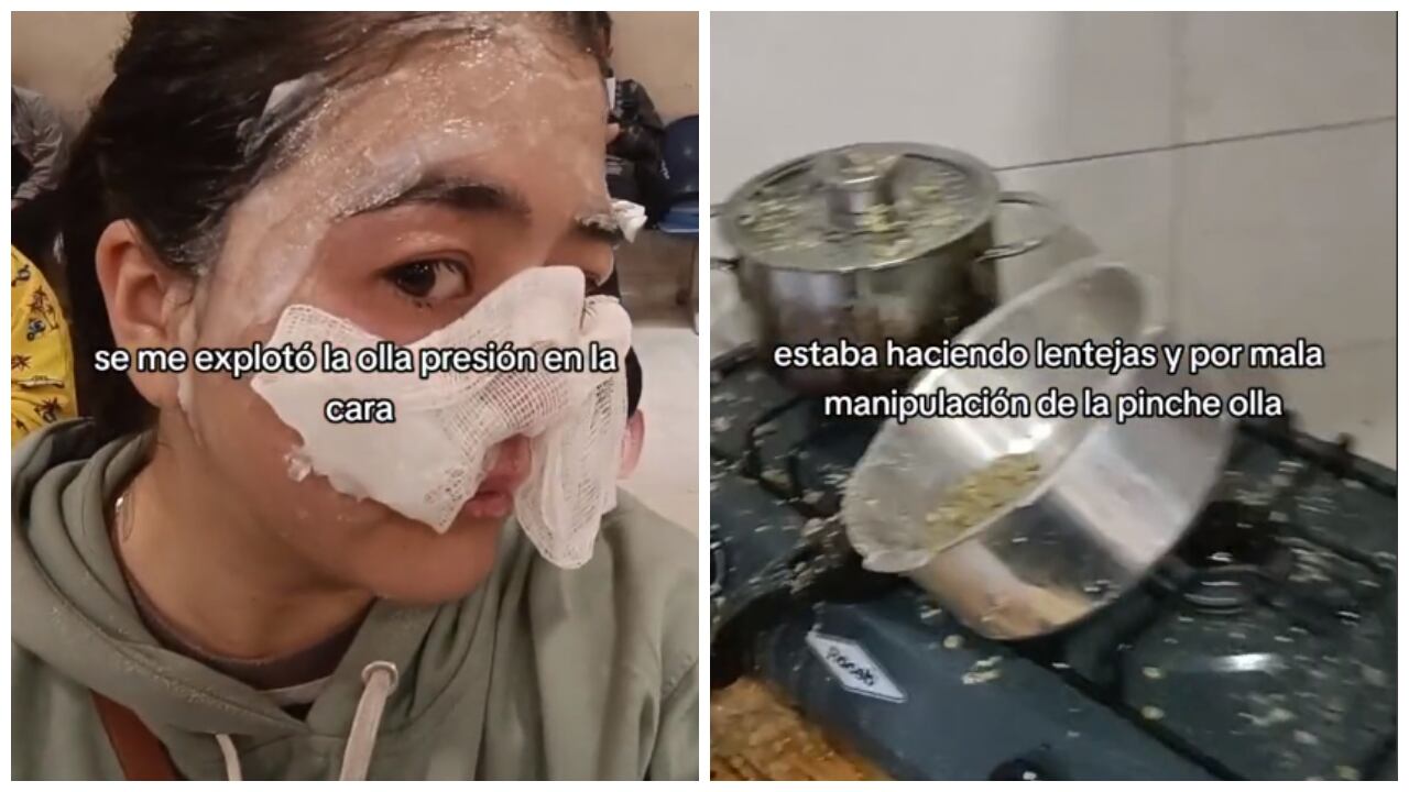 Video: joven sufre quemaduras en la cara tras explosión de olla a presión mientras preparaba lentejas