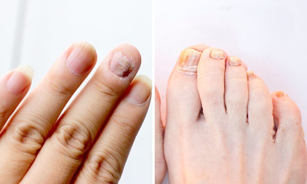 Los hongos en las uñas son más comunes de lo que se puede imaginar. Tienden a comenzar como una mancha blanca o amarilla amarronada debajo de la punta de la uña y puede ocurrir en las manos y en los pies.