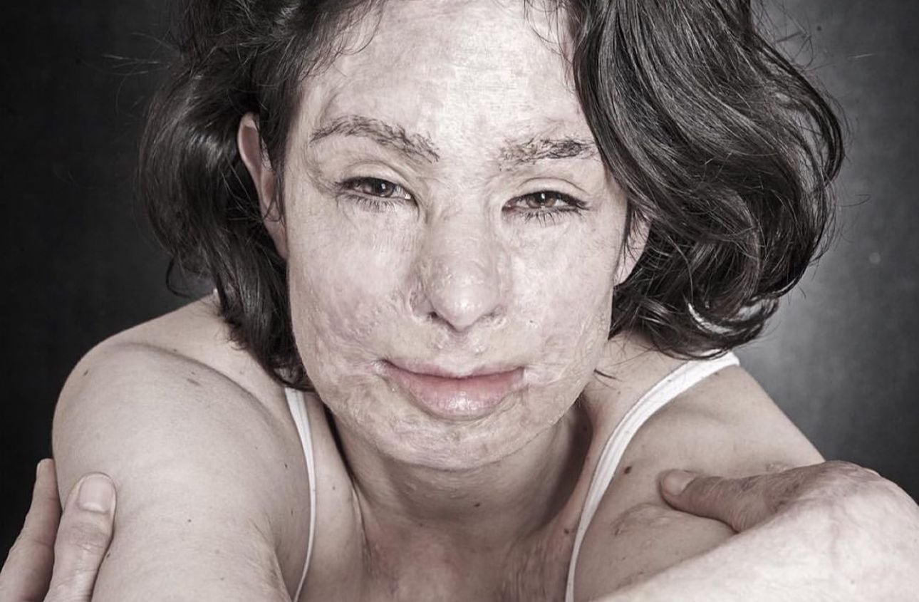 Natalia Ponce de León sufrió un ataque con ácido en el 2014