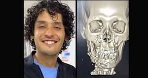 En la Subred Norte, un médico cirujano, reconstruyó el rostro de José Felipe Reyes, joven que fue lanzado por delincuentes desde un puente peatonal