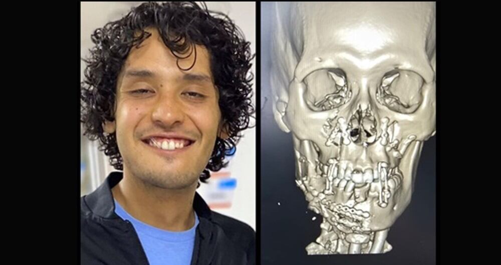 En la Subred Norte, un médico cirujano, reconstruyó el rostro de José Felipe Reyes, joven que fue lanzado por delincuentes desde un puente peatonal