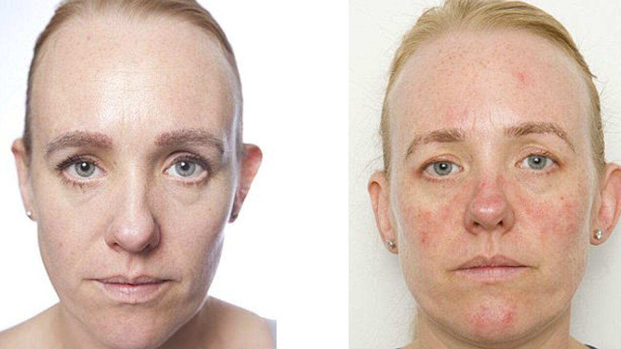 Un dermatólogo inglés le dijo a Anne Pusglove que durante su experimento de un mes, la piel había envejecido 10 años.