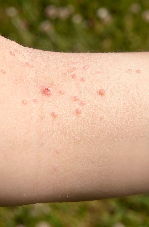 Ciertos tipos de verrugas pueden ser contagiosos.