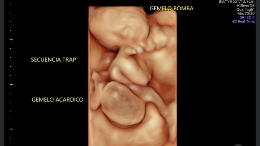 Gemelos con una condición denominada secuencia TRAP.