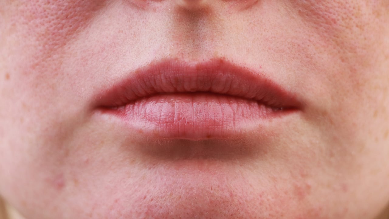 Poros abiertos en el rostro