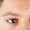 Cualquier persona puede sufrir de acné.