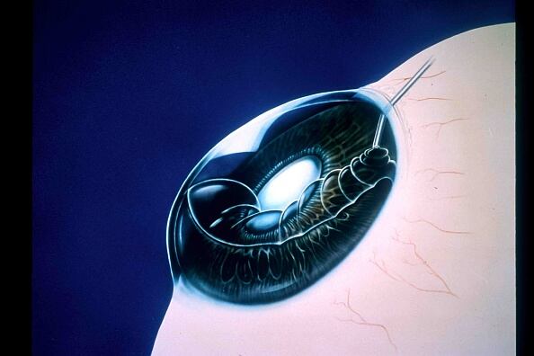 Un cambio en el color del iris de los ojos se puede presentar también por la aparición del síndrome endotelial iridocorneal, EIC, que se presenta cuando hay una combinación poco común de tres afecciones que impactan el iris y la córnea.  (Photo by: GILLES/BSIP/Universal Images Group via Getty Images)