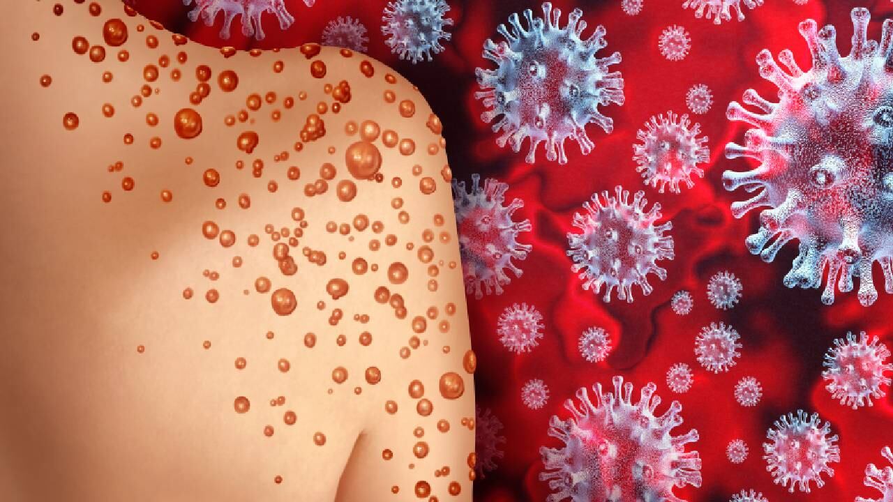 La OMS asegura que la viruela del mono no tiene la misma incidencia mundial que tuvo la covid-19, pero advierte que es importante mantenerla en el radar para evitar graves consecuencias. Foto: Getty images.