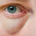 Bolsas en los ojos: Estos son los mejores remedios caseros para reducirlas