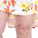 Las venas várices pueden presentarse por una mala circulación sanguínea.