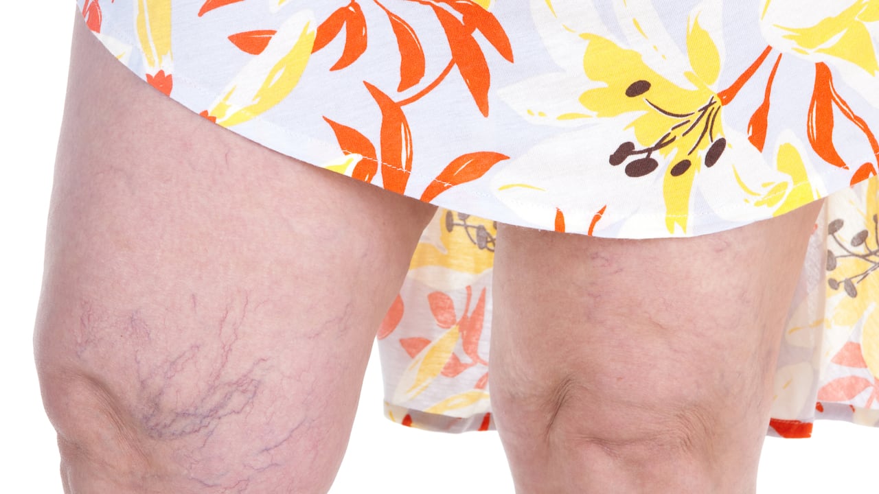 Las venas várices pueden presentarse por una mala circulación sanguínea.