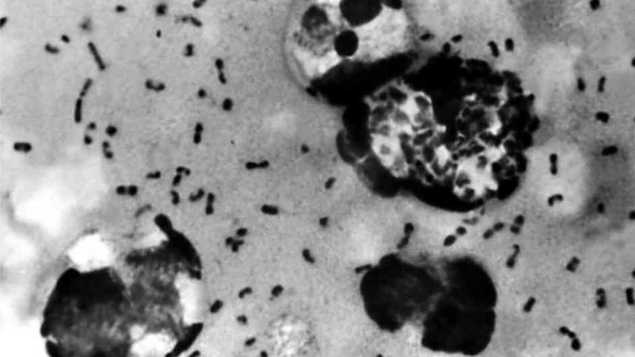 La peste bubónica se caracteriza por la inflamación de los ganglios linfáticos.