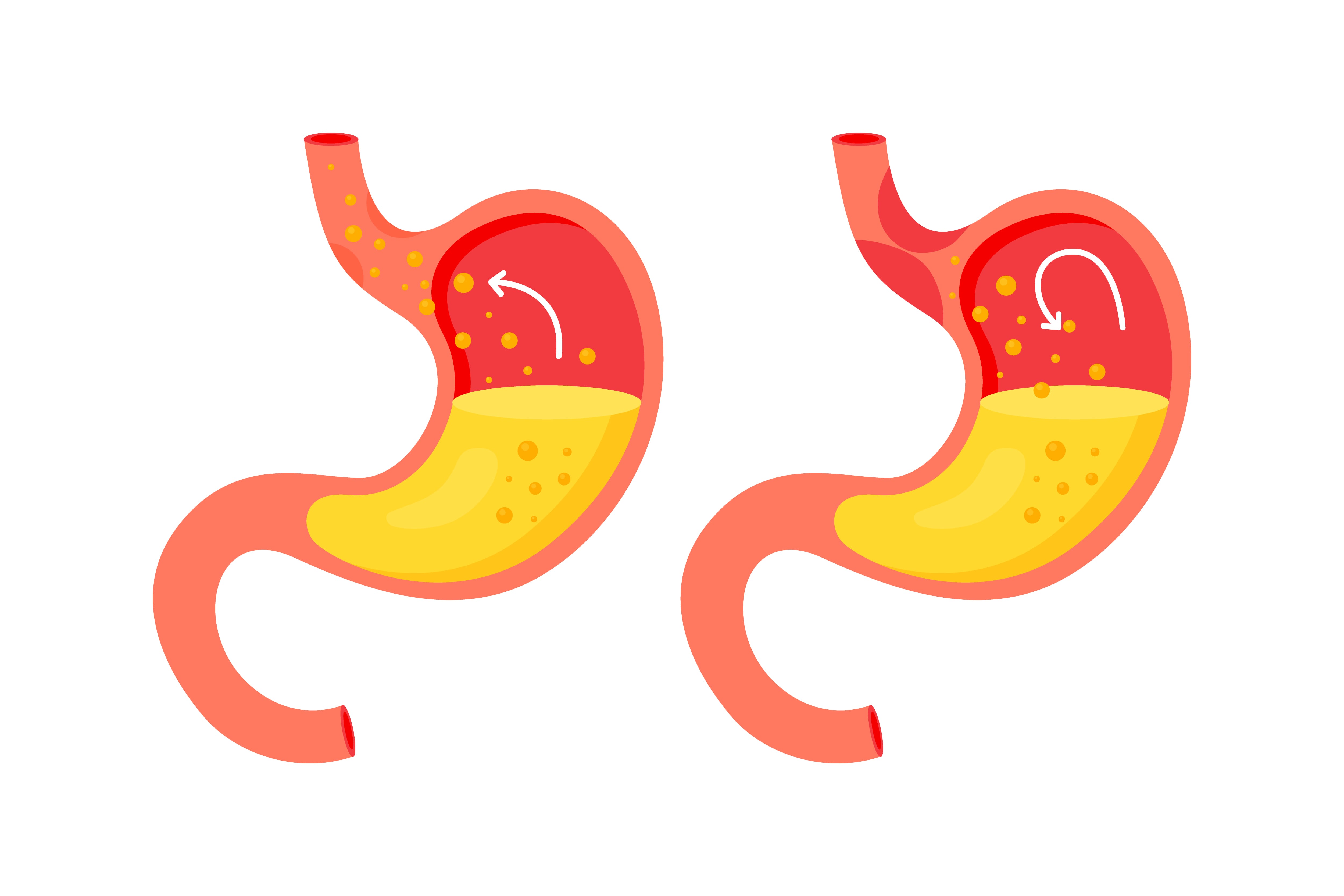 Gases en el estómago