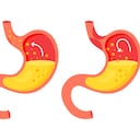 Gases en el estómago.